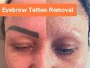 The Tattoo Removal Experts logo